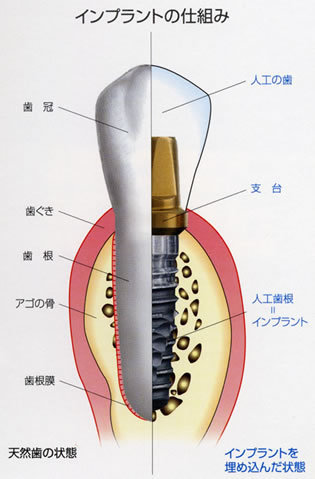 implant.jpg